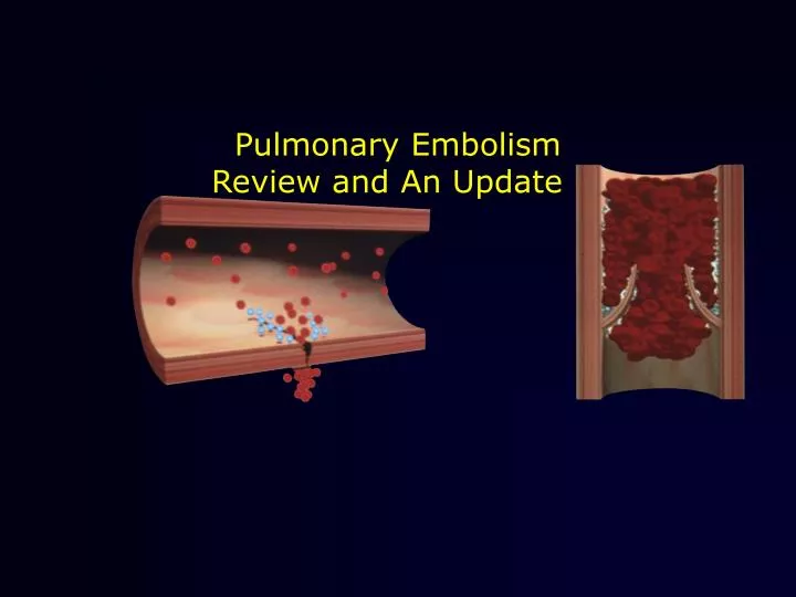 PPT - Pulmonary Embolism Review and An Update PowerPoint Presentation ...