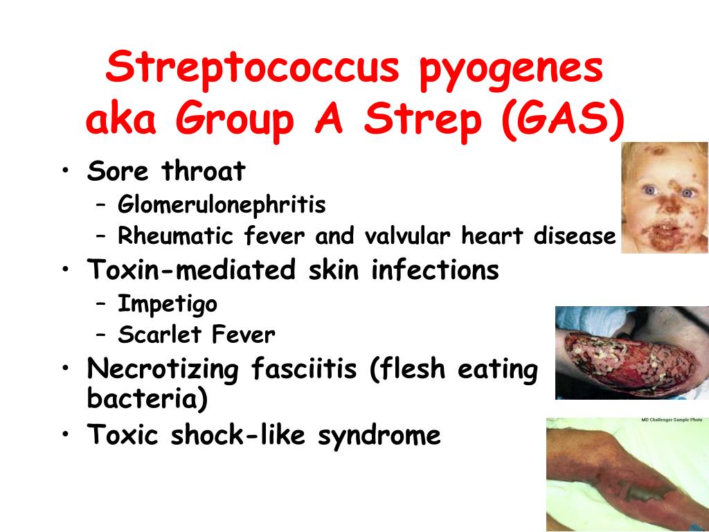 Streptococcus pyogenes aka Group A Strep (GAS) .