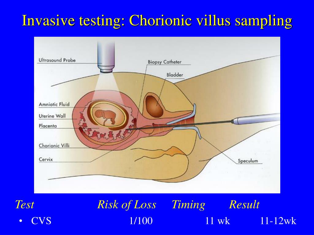 ppt prenatal diagnosis for joubert syndrome challenges chorionic villus sampling