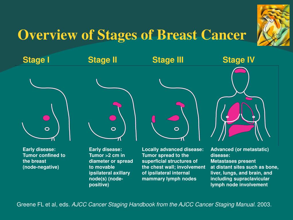 four-stages-of-breast-cancer