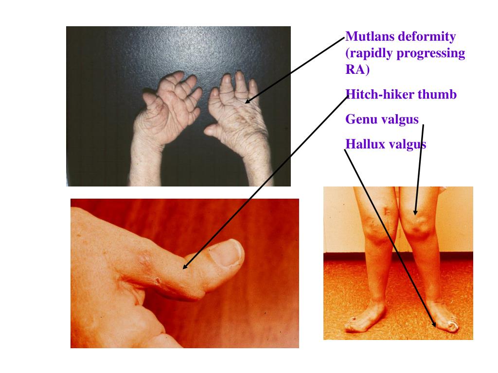 PPT Musculoskeletal Autoimmune; Inflammatory; Metabolic; Infectious