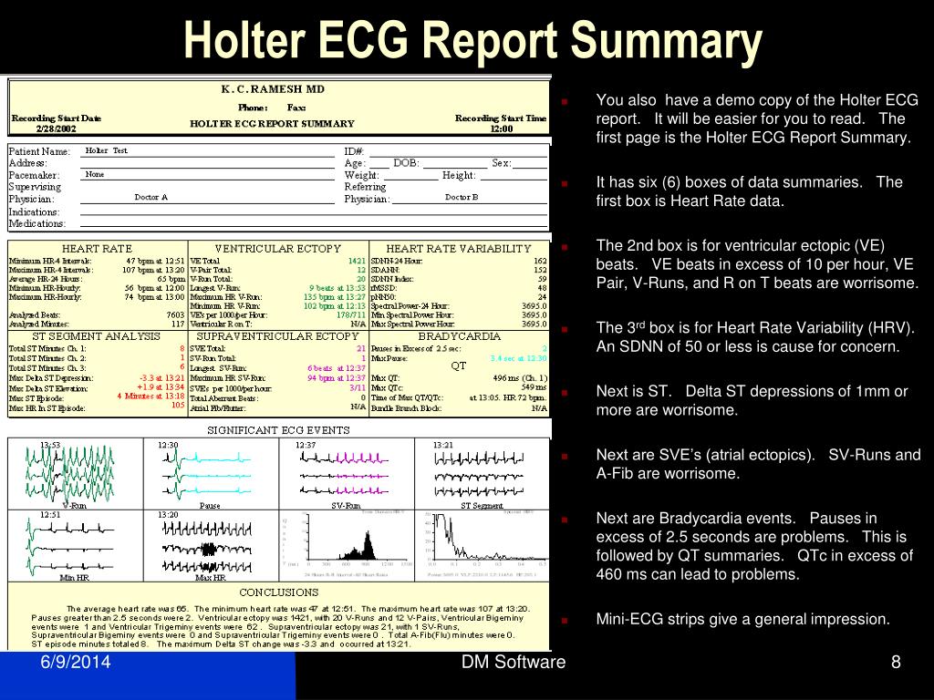 Summary report. ECG reporting. Holter ECG Results. Holter monitoring Result example. Rundown Report.