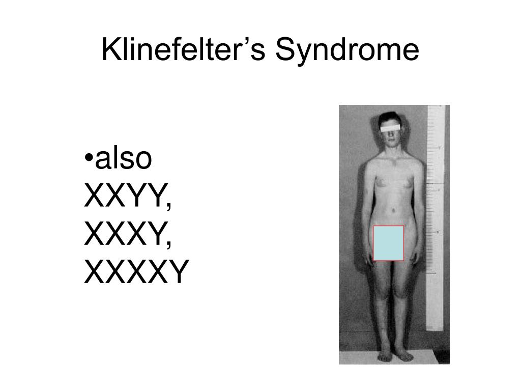 Klinefelter S Syndrome Xxy Ideas Klinefelter Syndrome Chromosome | My ...