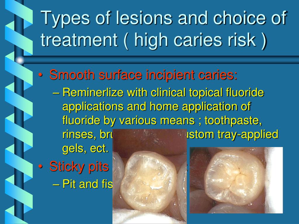 PPT Treatment of dental caries as an infectious disease PowerPoint