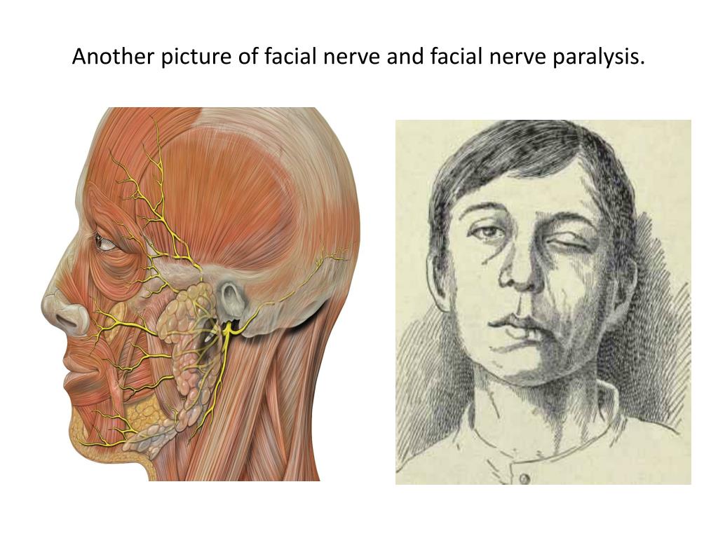 Поврежден лицевой нерв. Лицевой нерв. Воспаление лицевого нерва. Лицевой нерв неврология. Защемление лицевого нерва.