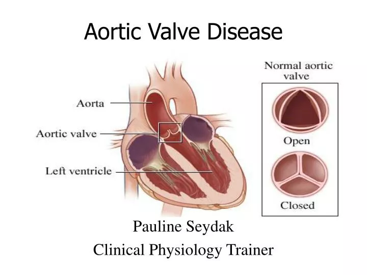 PPT - Aortic Valve Disease PowerPoint Presentation, free download - ID ...