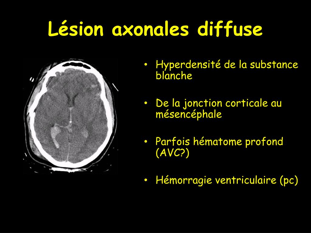 PPT - Cascade Physiopathologique de l’agression cérébrale PowerPoint ...