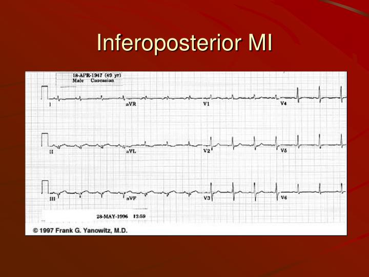 PPT - EKG Myocardial infarction and other ischemic states PowerPoint ...