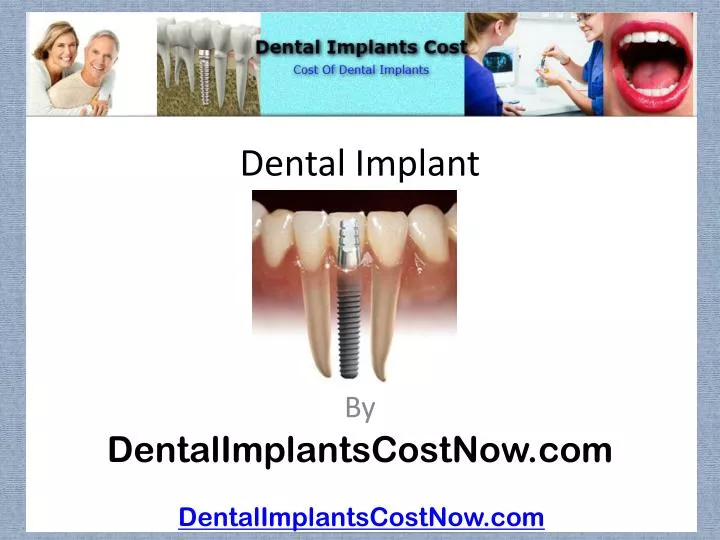 dental implant n.