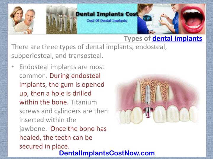 ppt dental implant powerpoint presentation id 393040 endosteal implant