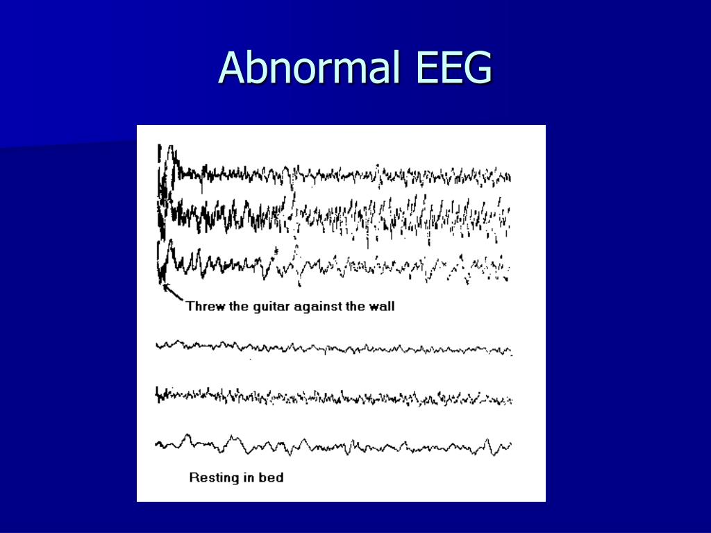 What Does An Abnormal Eeg Look Like