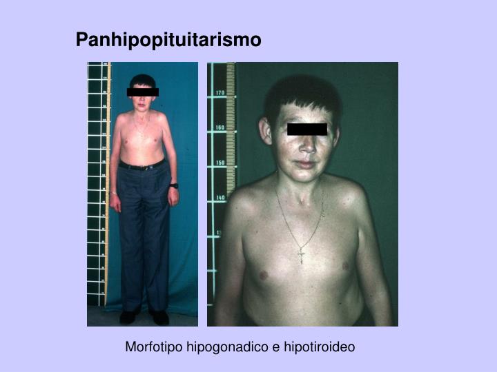 Resultado de la imagen para panhipopituitarismo