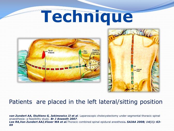PPT Segmental Thoracic Spinal Anesthesia PowerPoint Presentation ID403778