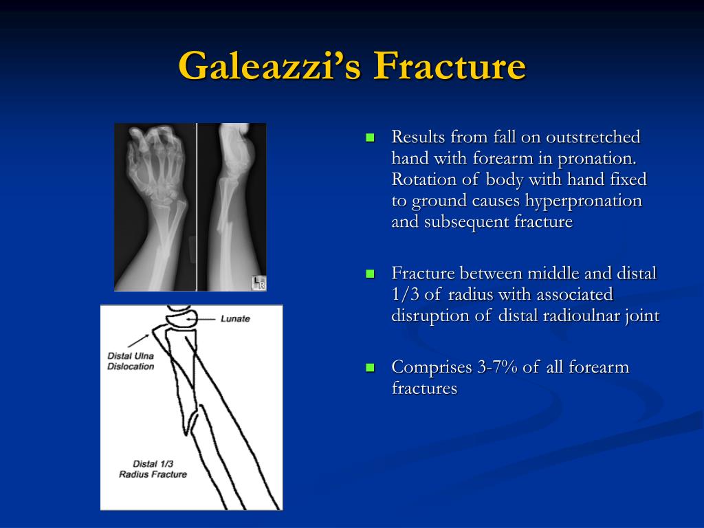 galeazzi fracture diagram galeazzi fracture diagram