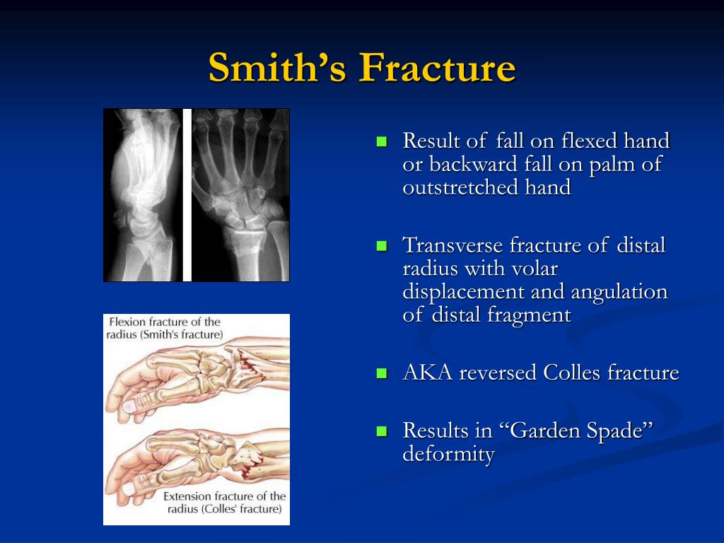 Ppt Common Fracture Eponyms