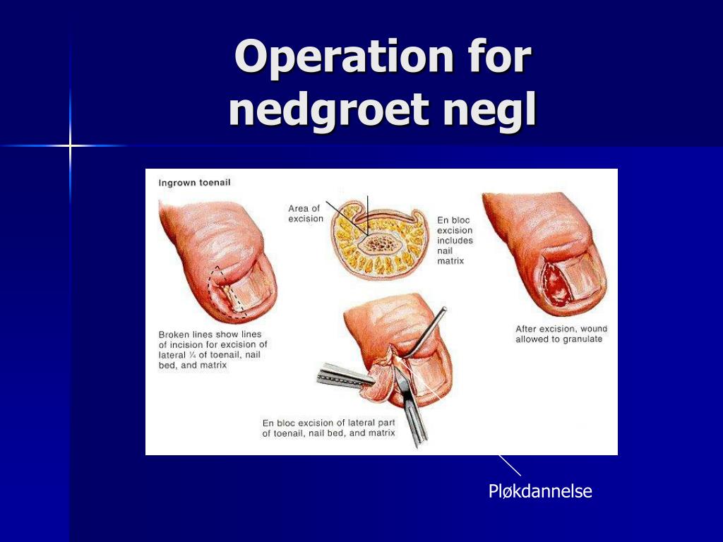 PPT Småoperationer på huden v Robert PowerPoint free download -