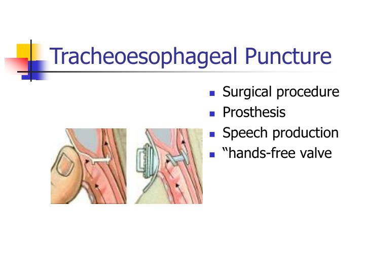 Ppt Laryngectomy Powerpoint Presentation Id 417258