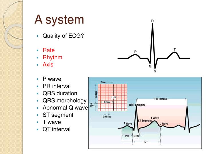 PPT - ECG interpretation for beginners - 1 PowerPoint Presentation - ID ...