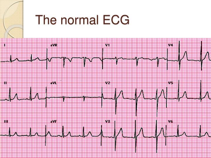 PPT - ECG interpretation for beginners - 1 PowerPoint Presentation - ID ...