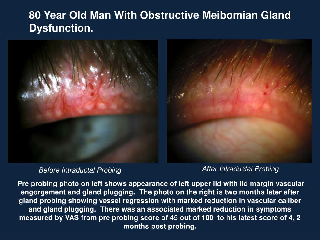 PPT Results Of Intraductal Meibomian Gland Probing MGP For Symptoms 