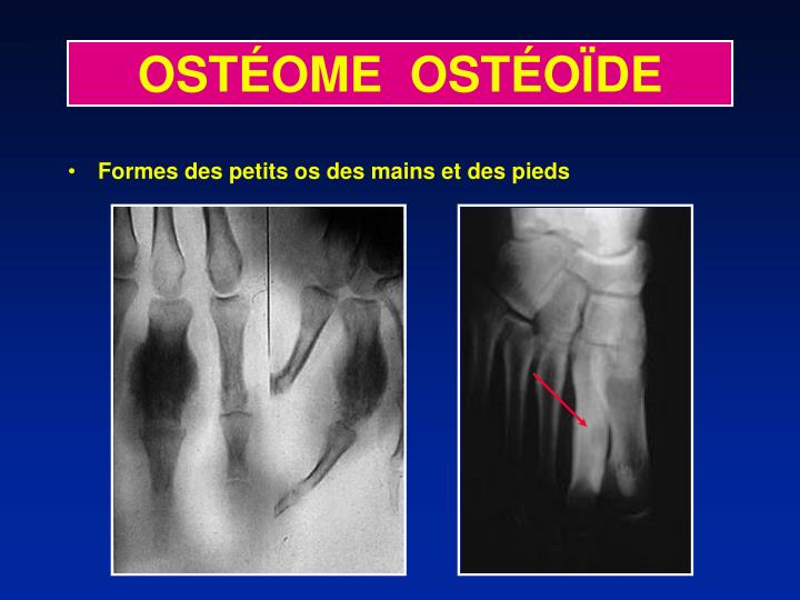 PPT - OSTÉOME OSTÉOÏDE PowerPoint Presentation - ID:423155
