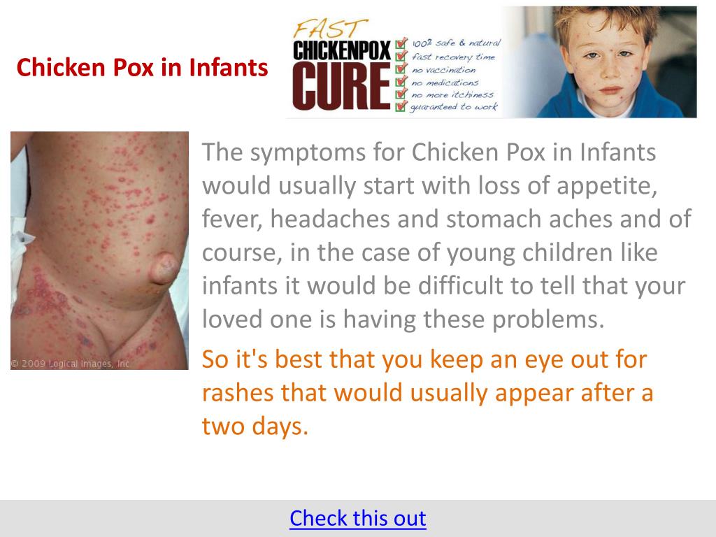 PPT - Chicken Pox in Infants PowerPoint Presentation, free download