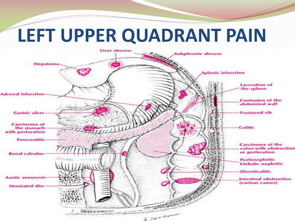 Upper Back Pain Causes