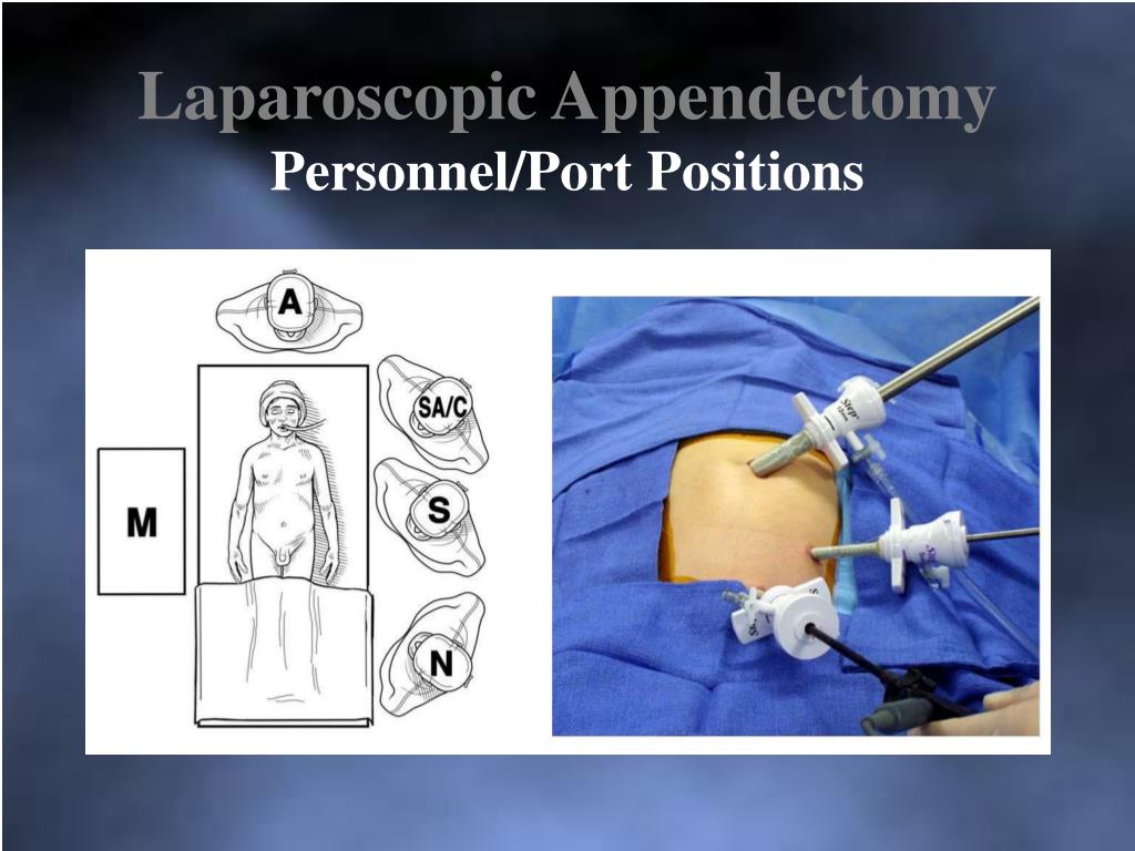 PPT - Appendicitis: Current Management PowerPoint Presentation, free ...