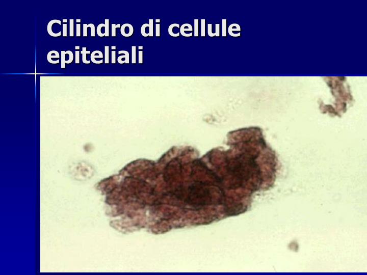 Cellule Pavimentose Delle Basse Vie Urinarie