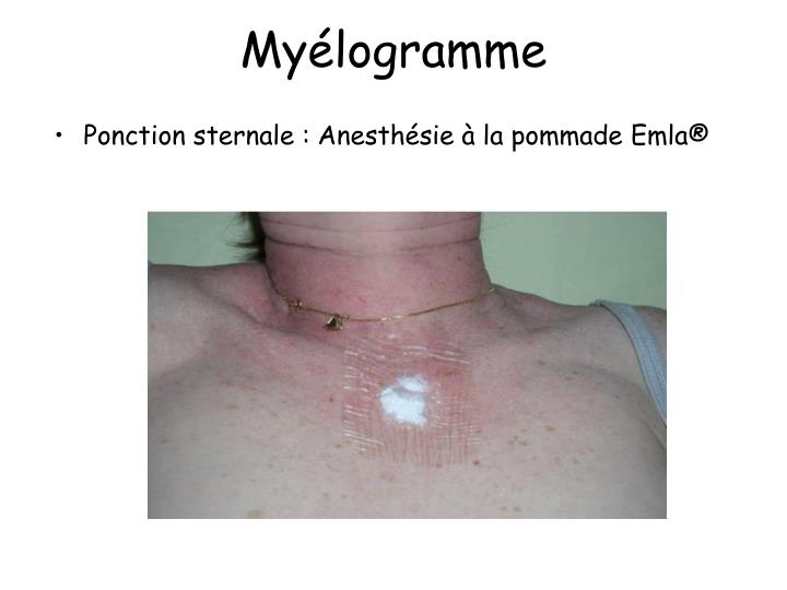 ppt-my-logramme-et-biopsie-ost-o-m-dullaire-powerpoint-presentation