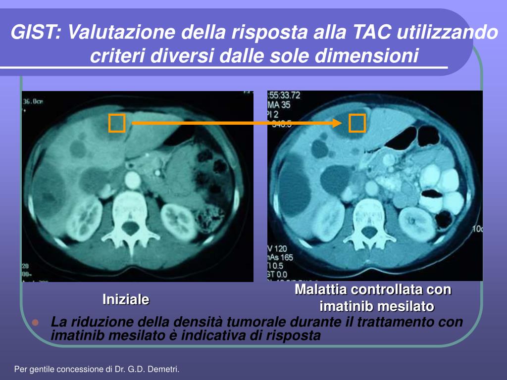 Ppt Aggiornamenti In Tema Di Sarcomi Delle Parti Molli E