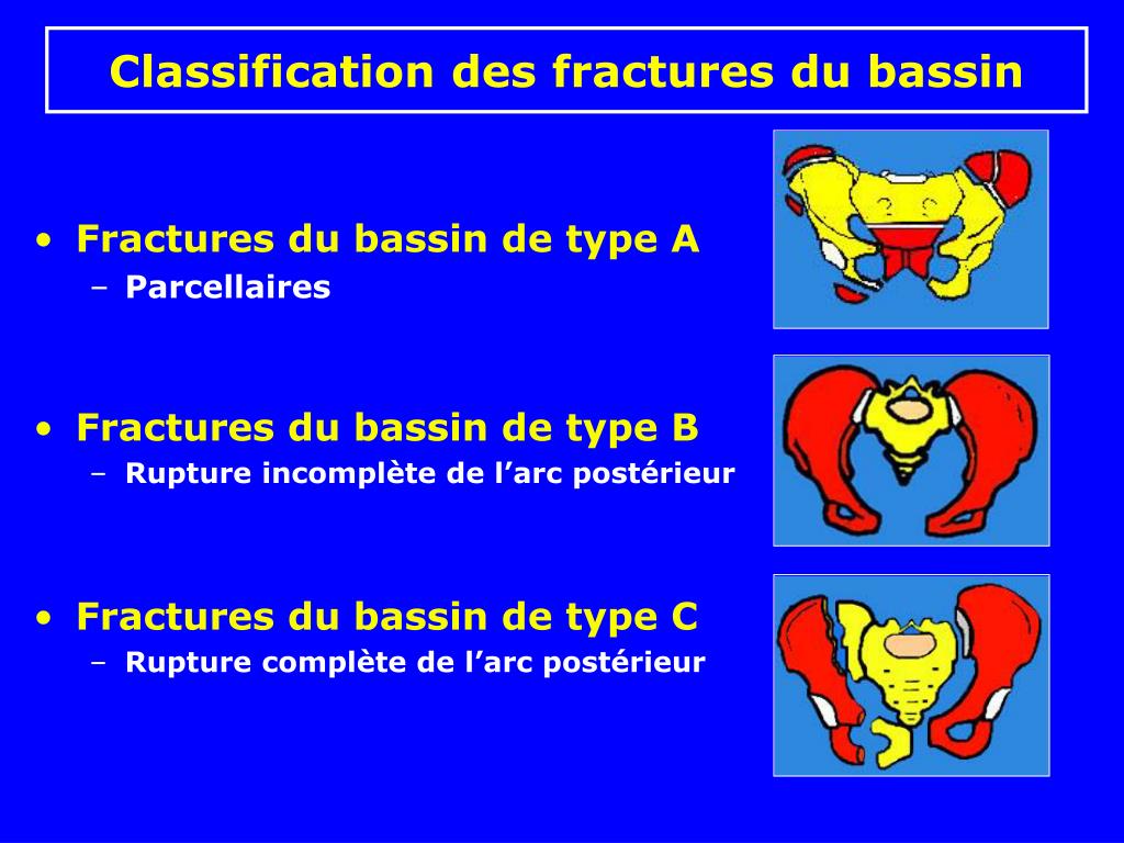PPT - Fractures du bassin PowerPoint Presentation, free download - ID:456006
