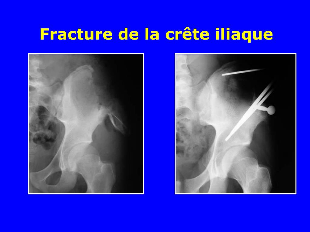 Fractures du bassin Dr Lamine KANDJERA - ppt video online télécharger