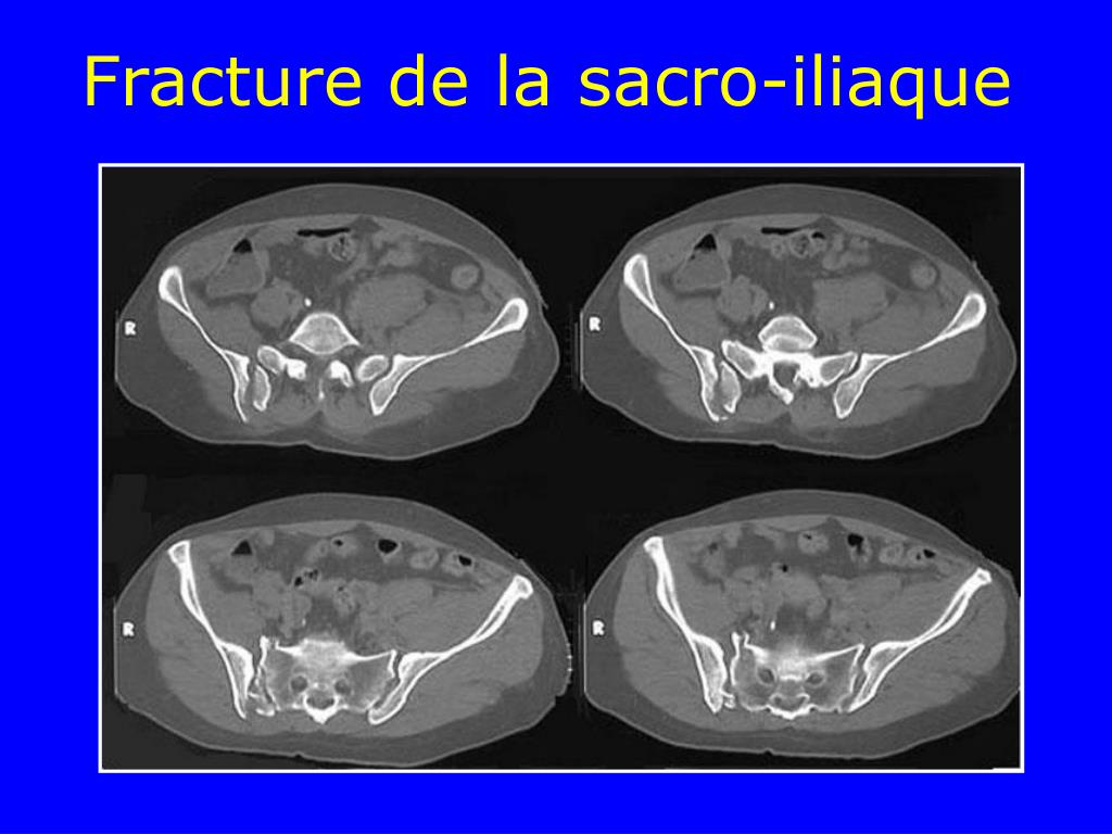 Fractures du bassin Dr Lamine KANDJERA - ppt video online télécharger