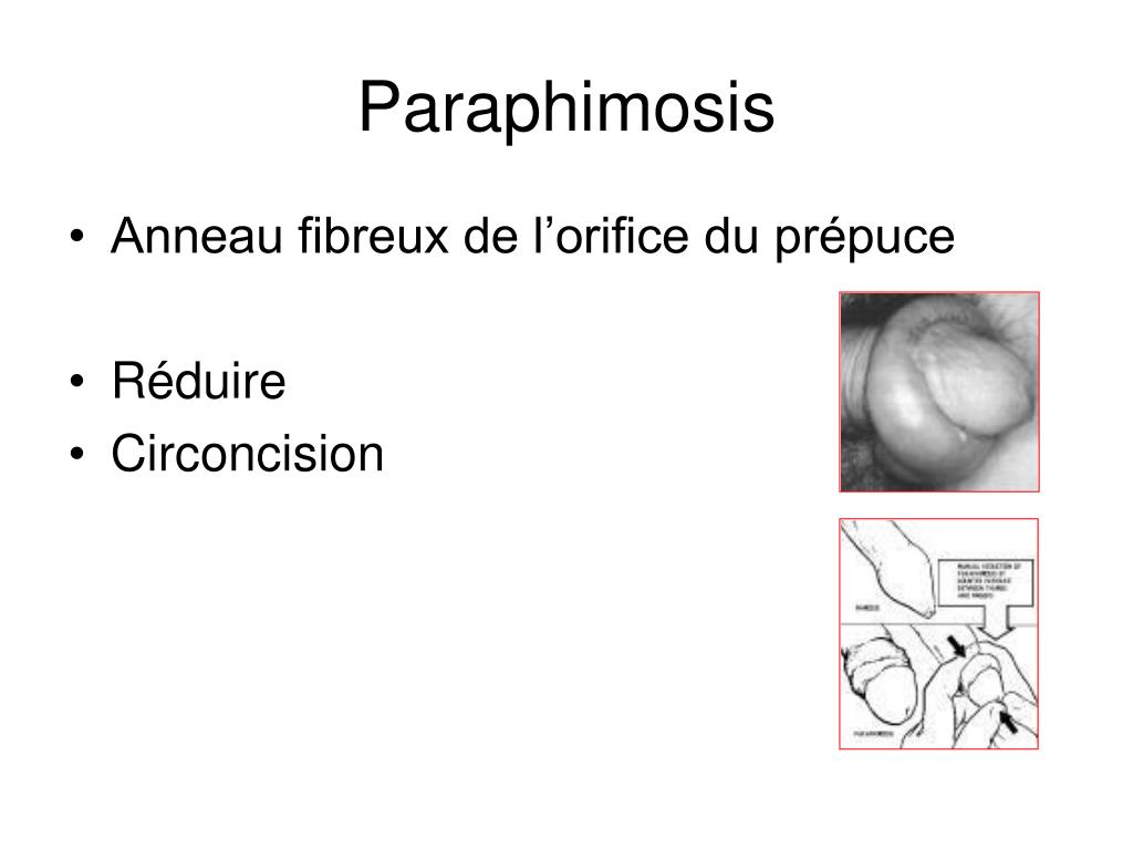 PPT - Pathologies génito-scrotales PowerPoint Presentation, free ...