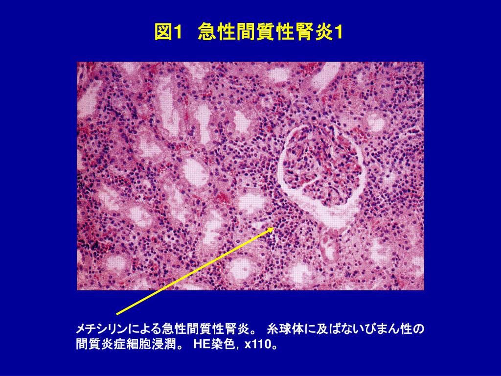 急性尿細管壊死の治療