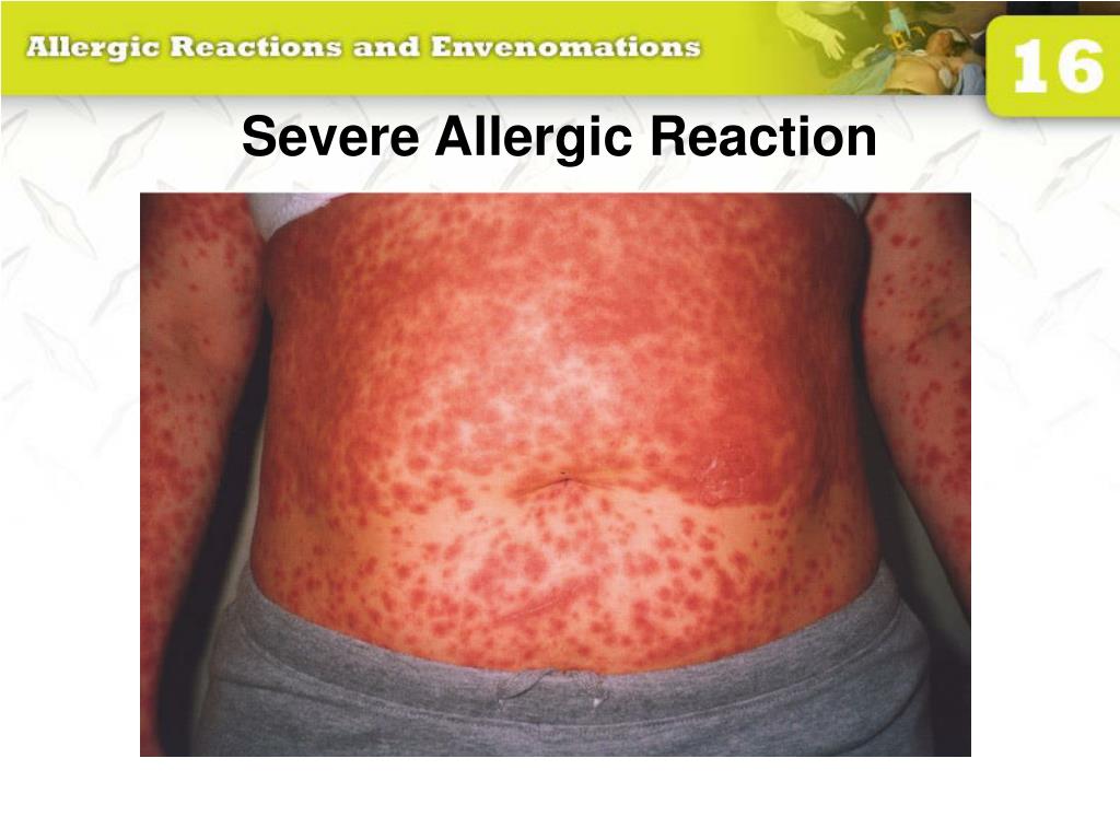 PPT - 16: Allergic Reactions And Envenomations PowerPoint Presentation ...