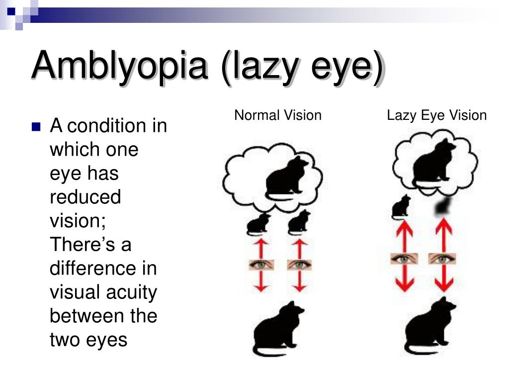 Normal Vision Lazy Eye Vision * A condition in which one eye has reduced vi...