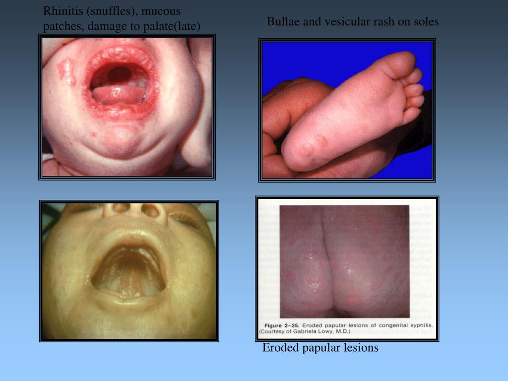 PPT - CONGENITAL SYPHILIS PowerPoint Presentation, free download - ID ...