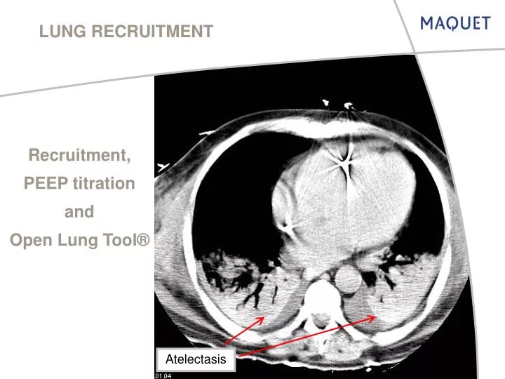 lung recruitment n.