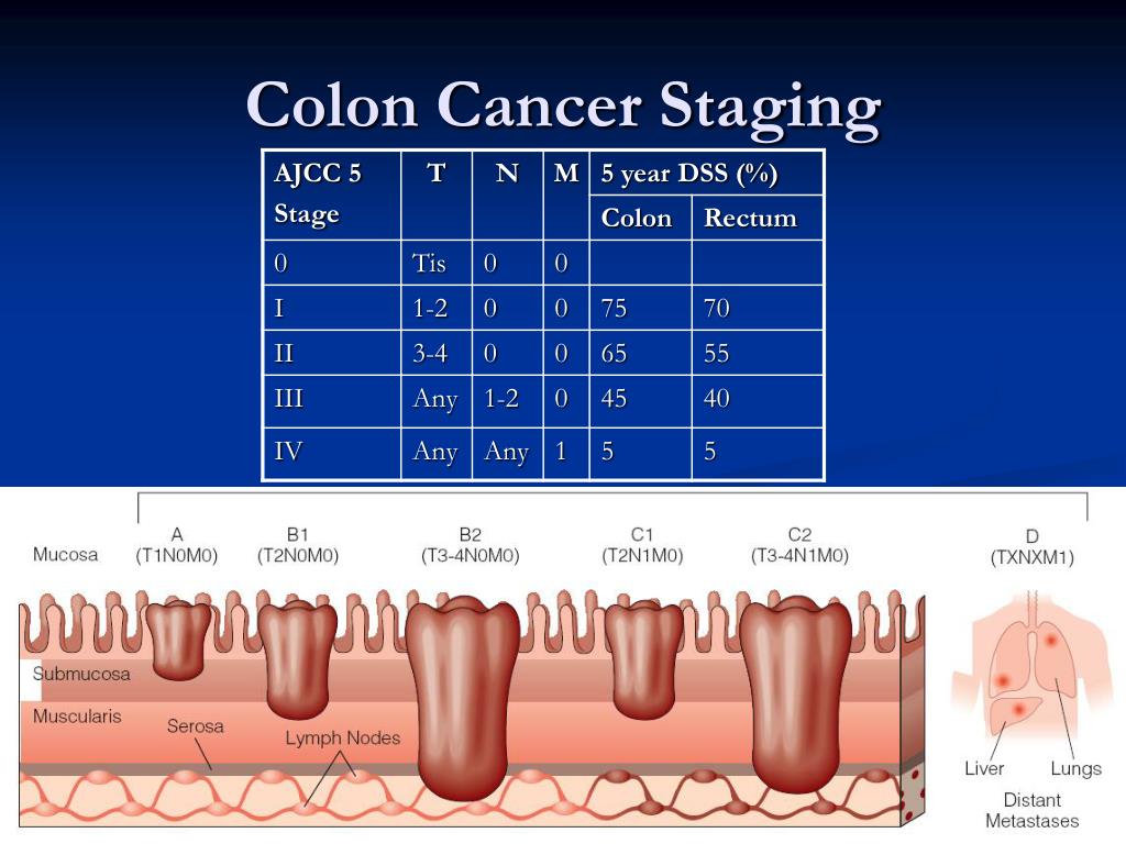 Colorectal Cancer Stages