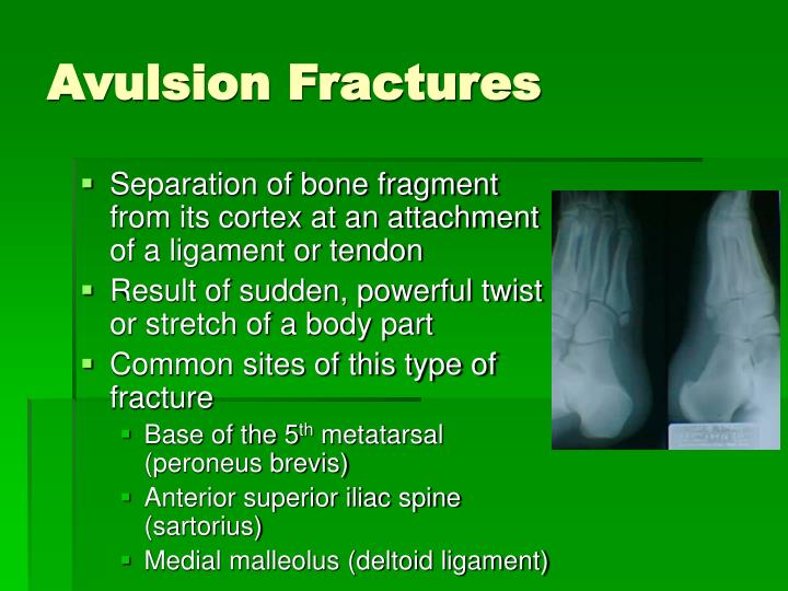 PPT Chapter 13 Recognizing Different Sports Injuries PowerPoint
