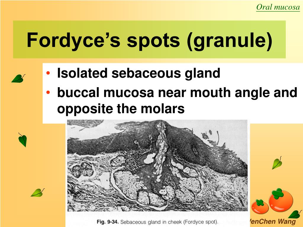 Fordyce Granules On Buccal Mucosa