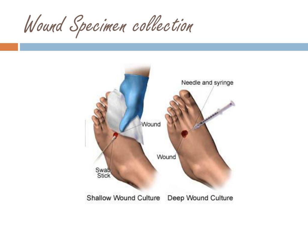 PPT Pus Abscesses And Sinuses Wound And Burn Cultures PowerPoint 