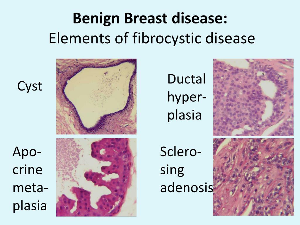 Ppt Breast Pathology Powerpoint Presentation Free Download Id486107