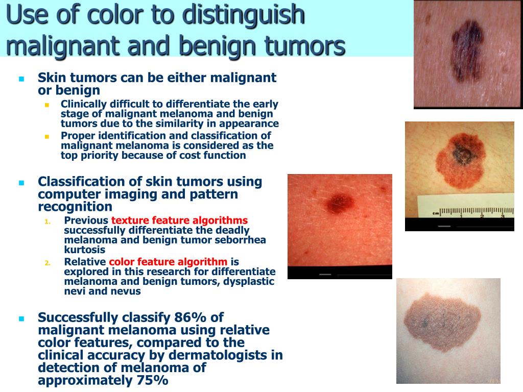 Benign Skin Cancer Types