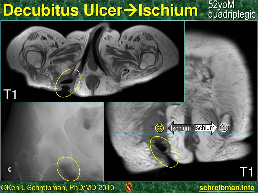 chronic left ischial tuberosity osteomyelitis icd 10