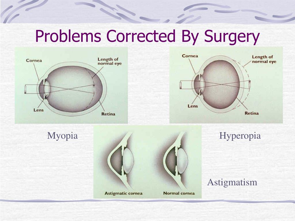surgery eye laser ppt corrected powerpoint myopia hyperopia problems presentation astigmatism slideserve