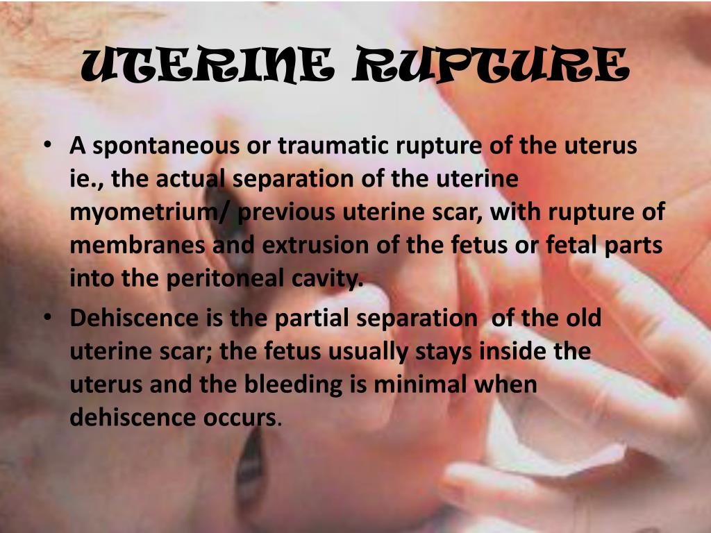 power point presentation on rupture uterus