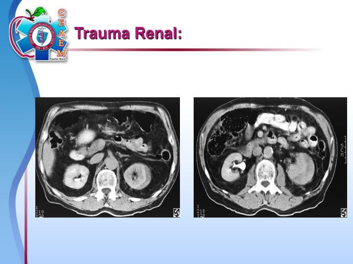 PPT - Trauma Romo y Heridas Penetrantes PowerPoint Presentation - ID:516078